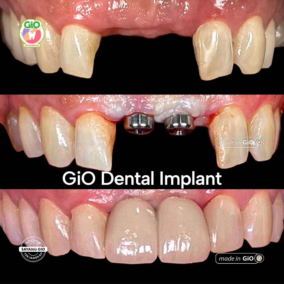 gio-ceramic-crown-bridge