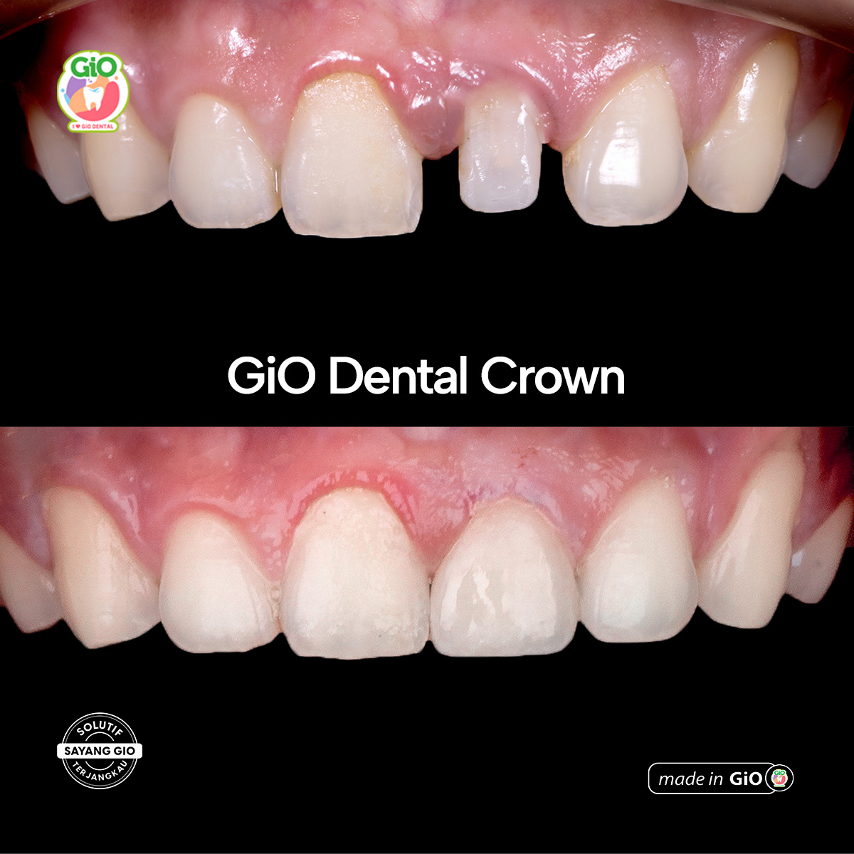 gio-ceramic-crown-bridge