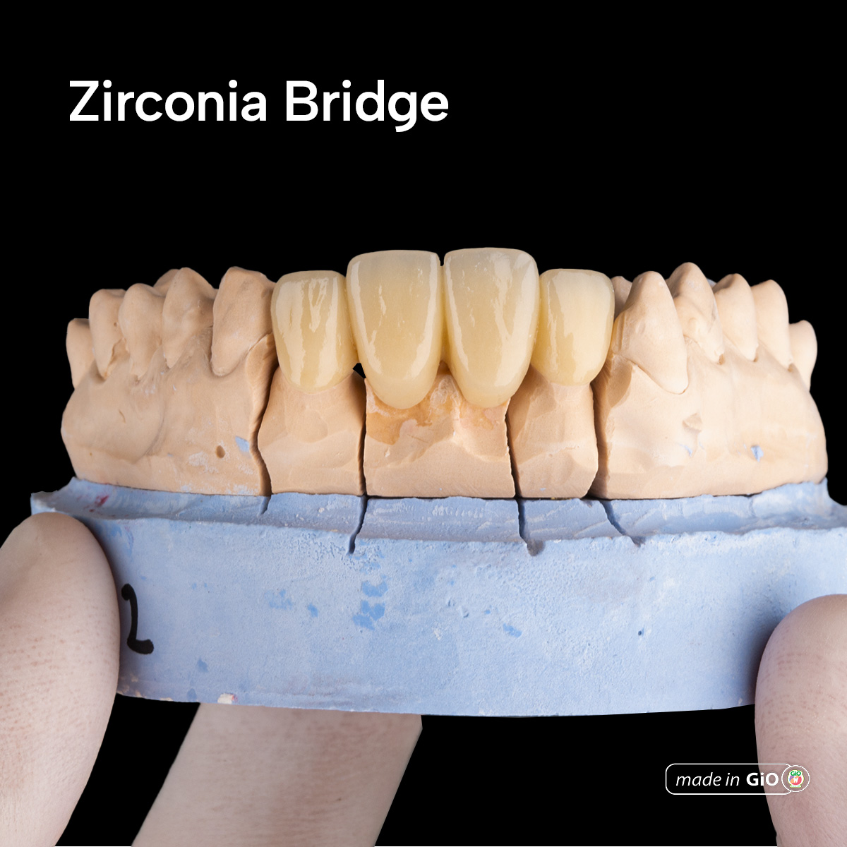 gio-ceramic-crown-bridge