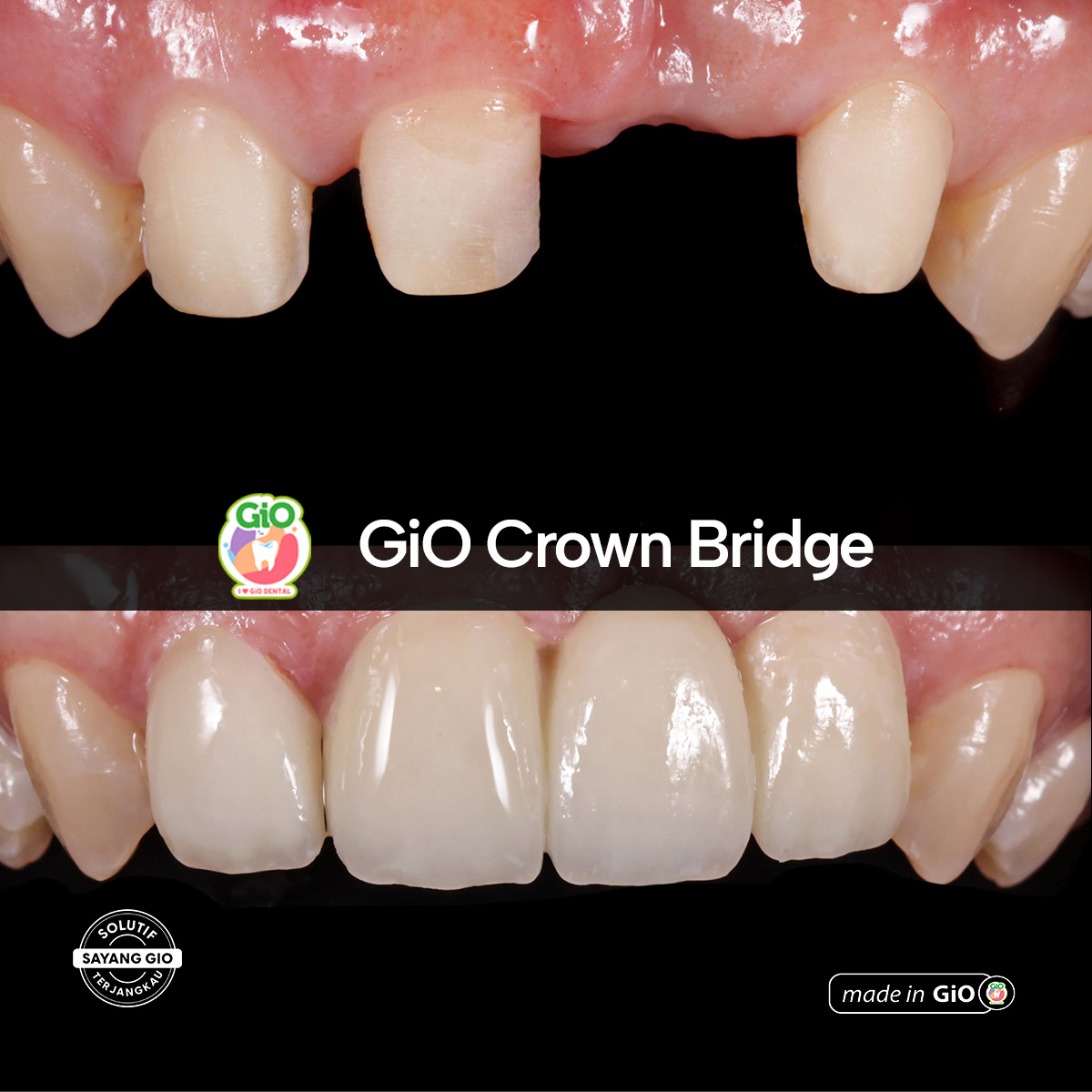gio-ceramic-crown-bridge