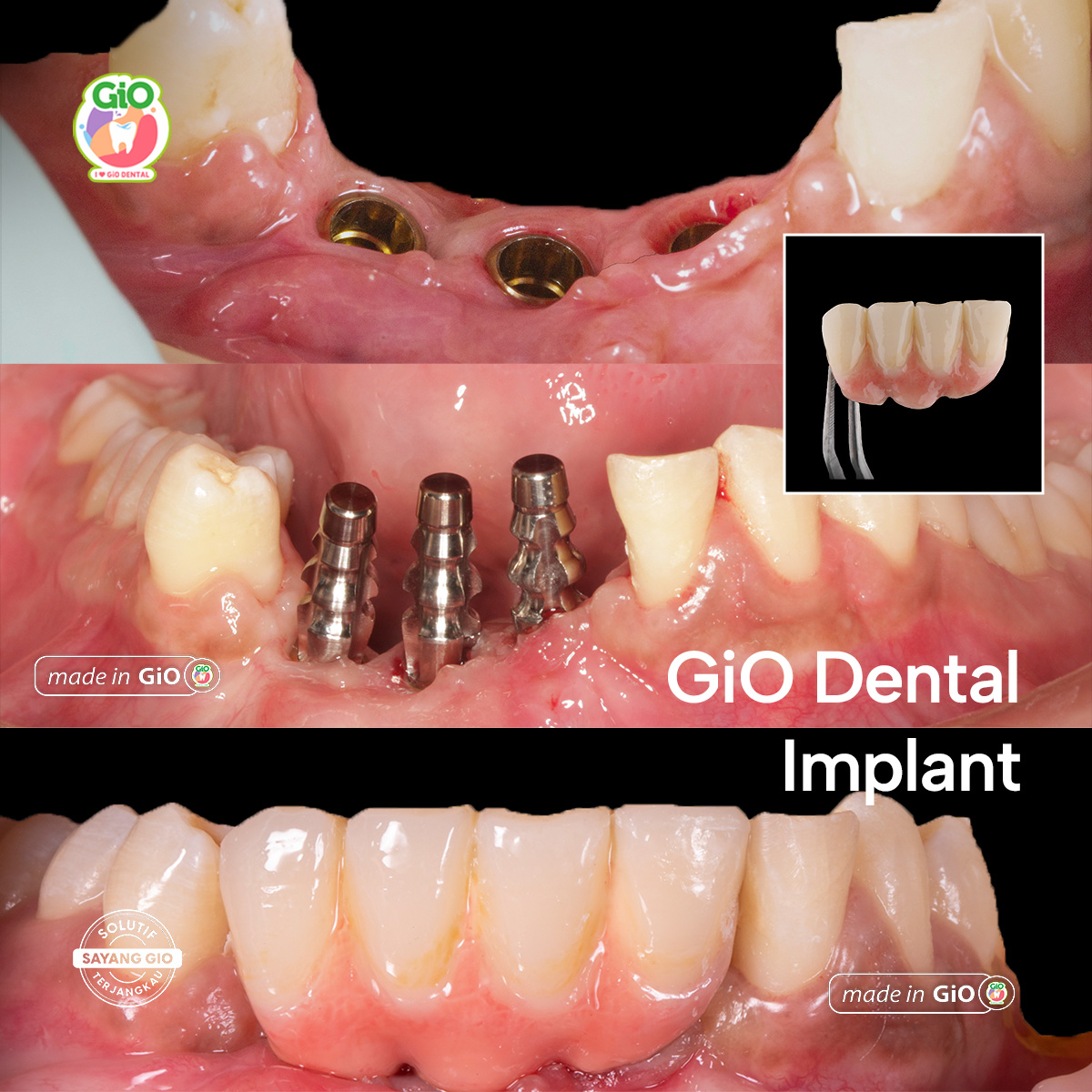 gio-ceramic-crown-bridge-and-implant