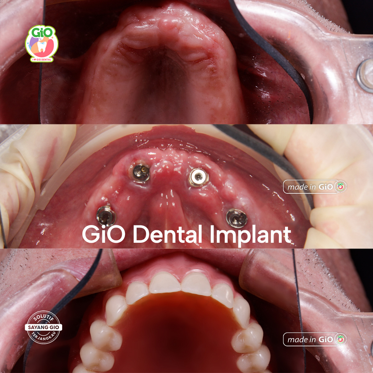 gio-ceramic-crown-bridge-and-implant
