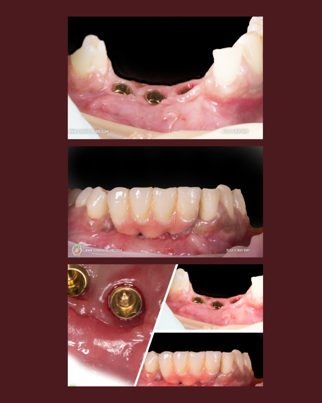 gio-dental-implants