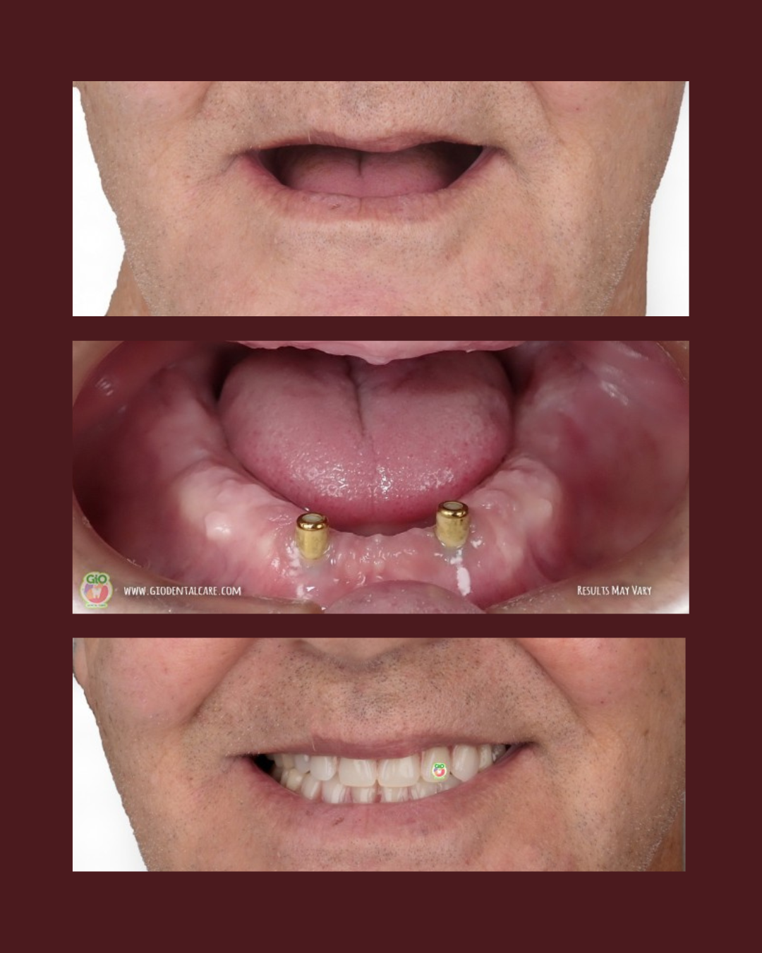 gio-dental-implants