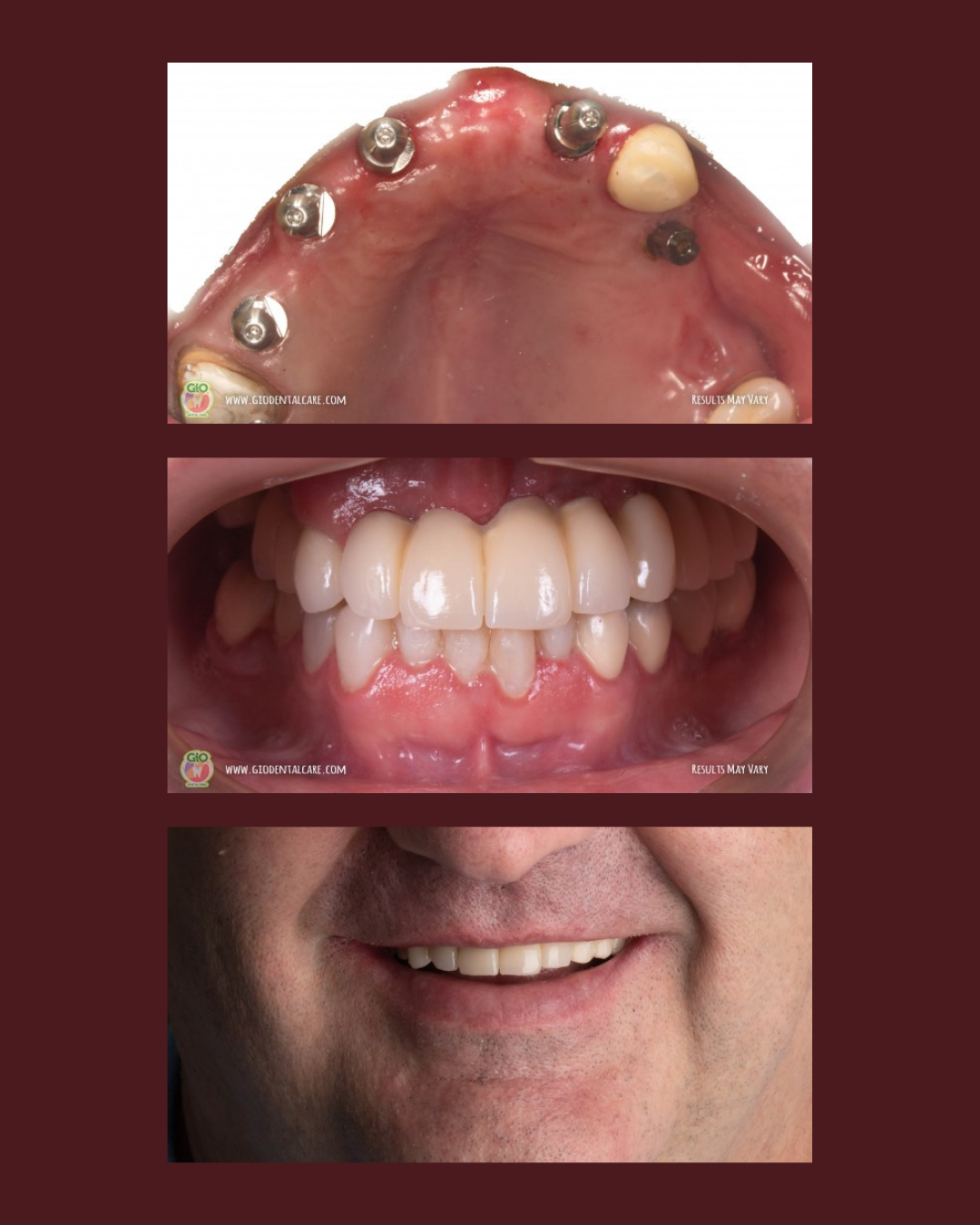 gio-dental-implants