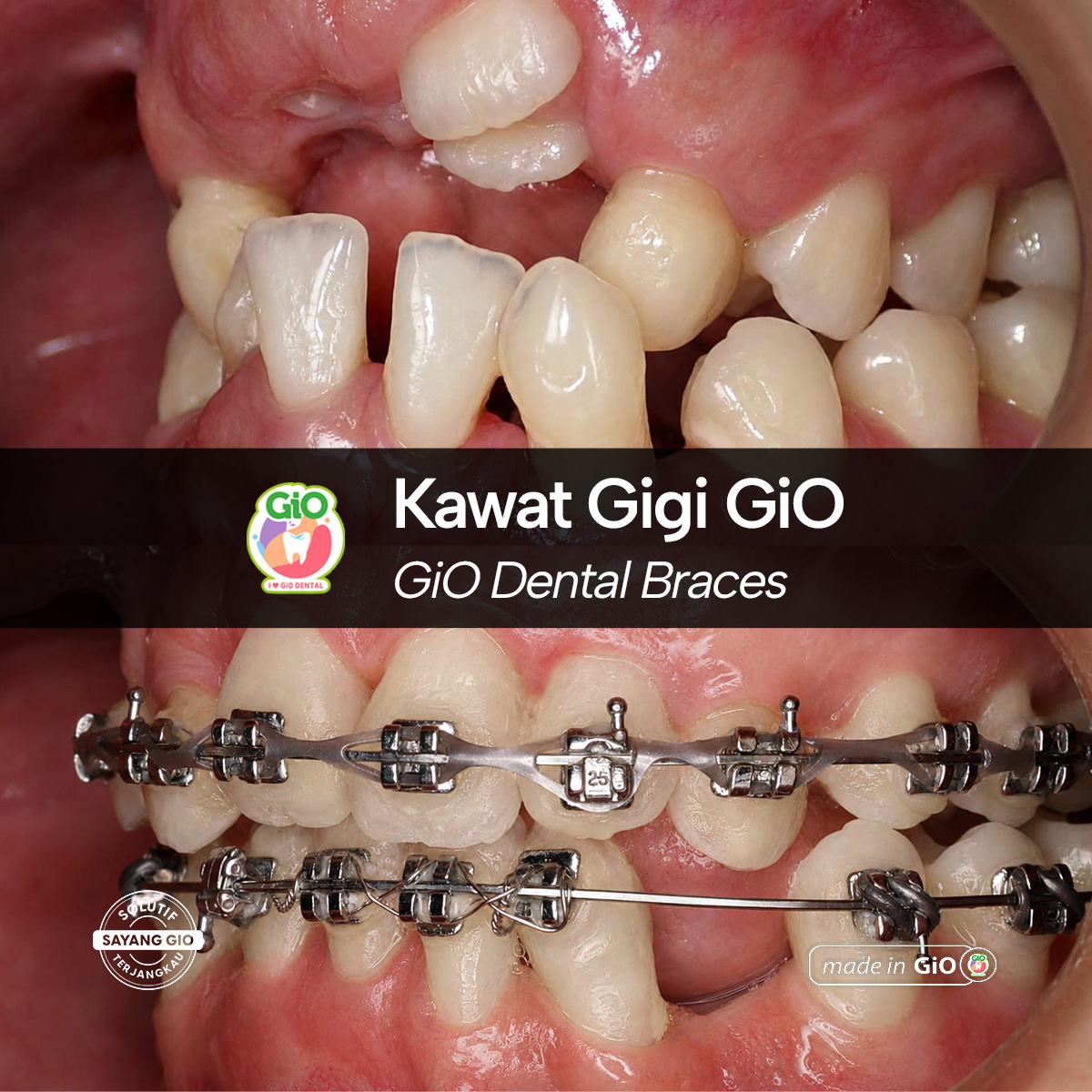 gio-kawat-gigi-american-metal-best-seller
