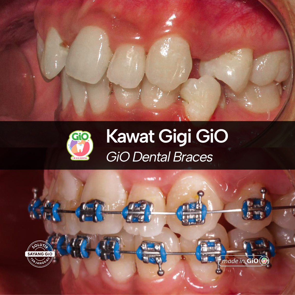 gio-kawat-gigi-american-metal-best-seller
