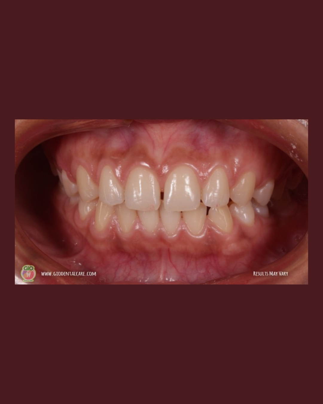 gio-kawat-gigi-transparan