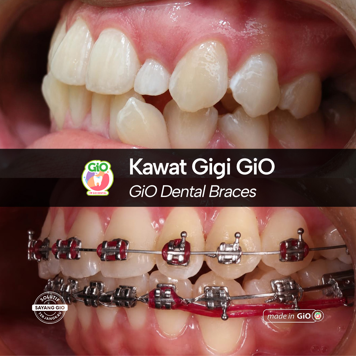 gio-self-ligating-braces