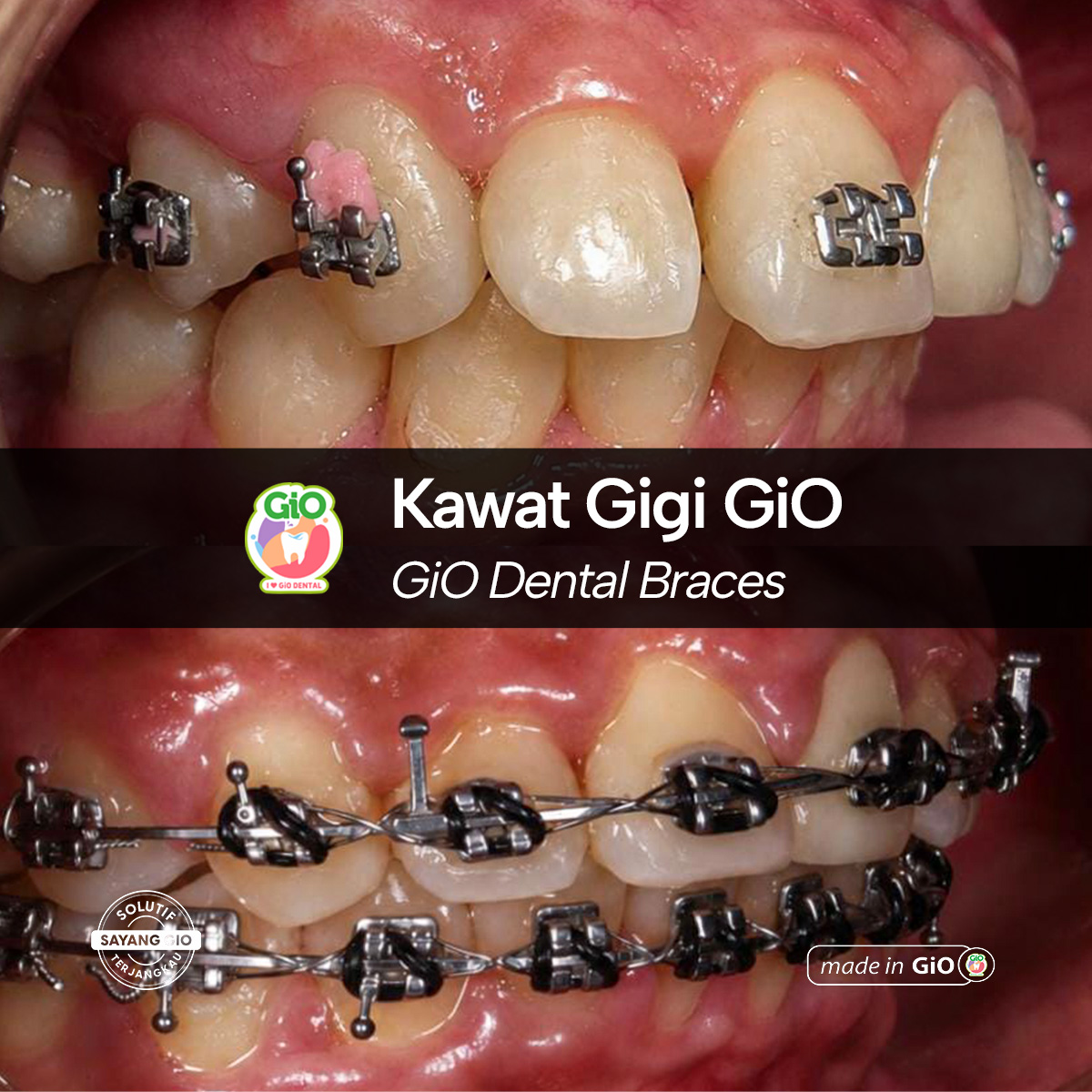 gio-self-ligating-braces