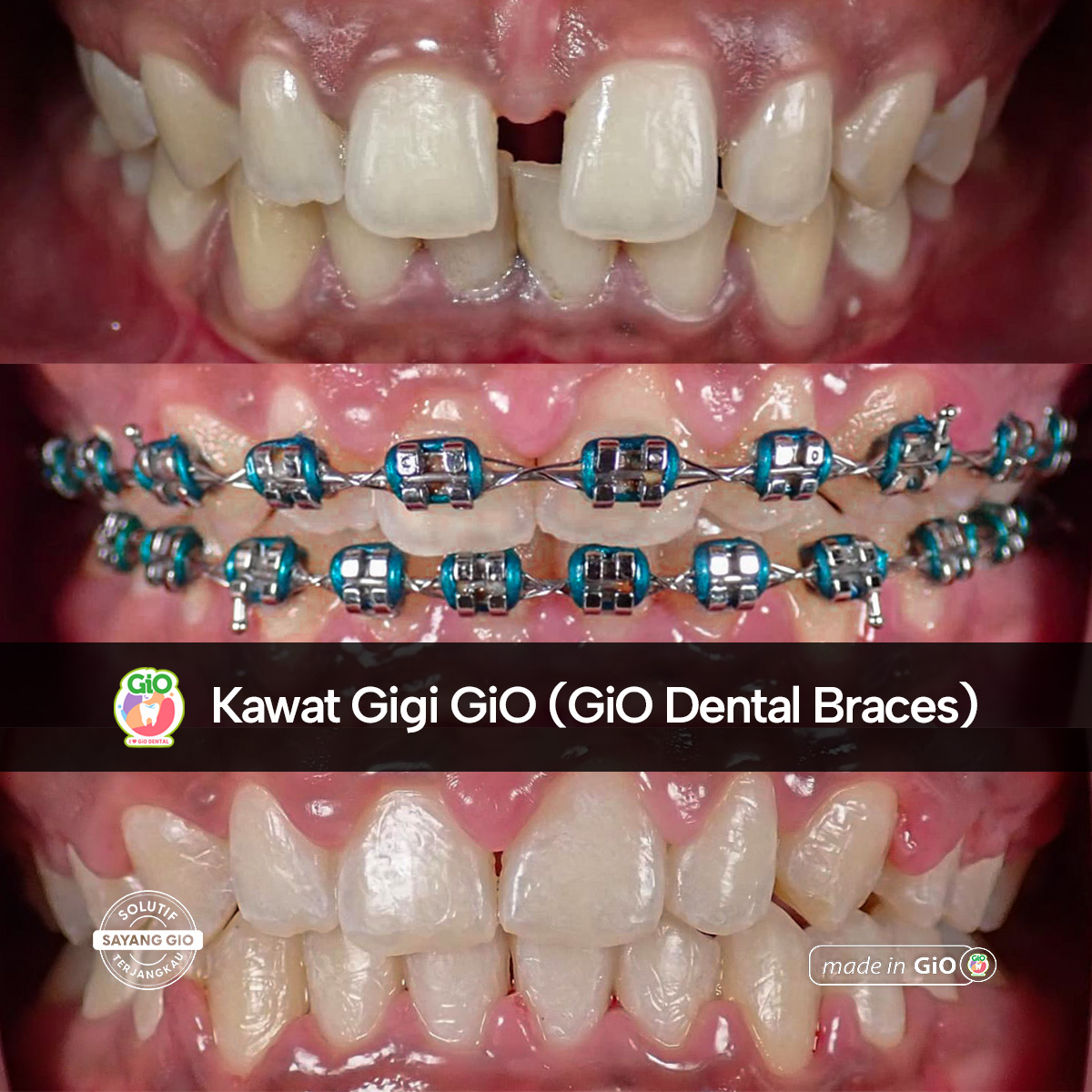 gio-self-ligating-braces