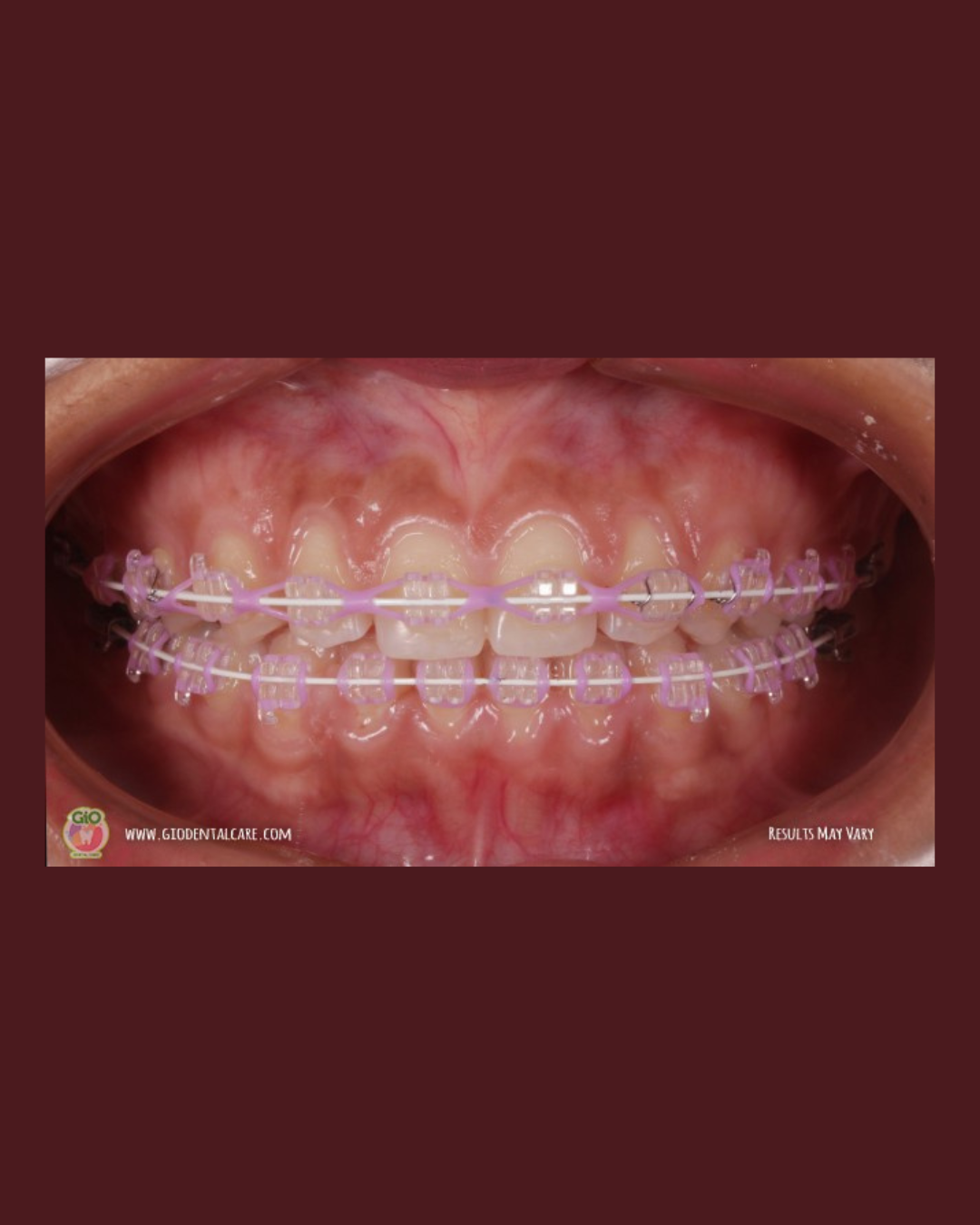 gio-kawat-gigi-transparan