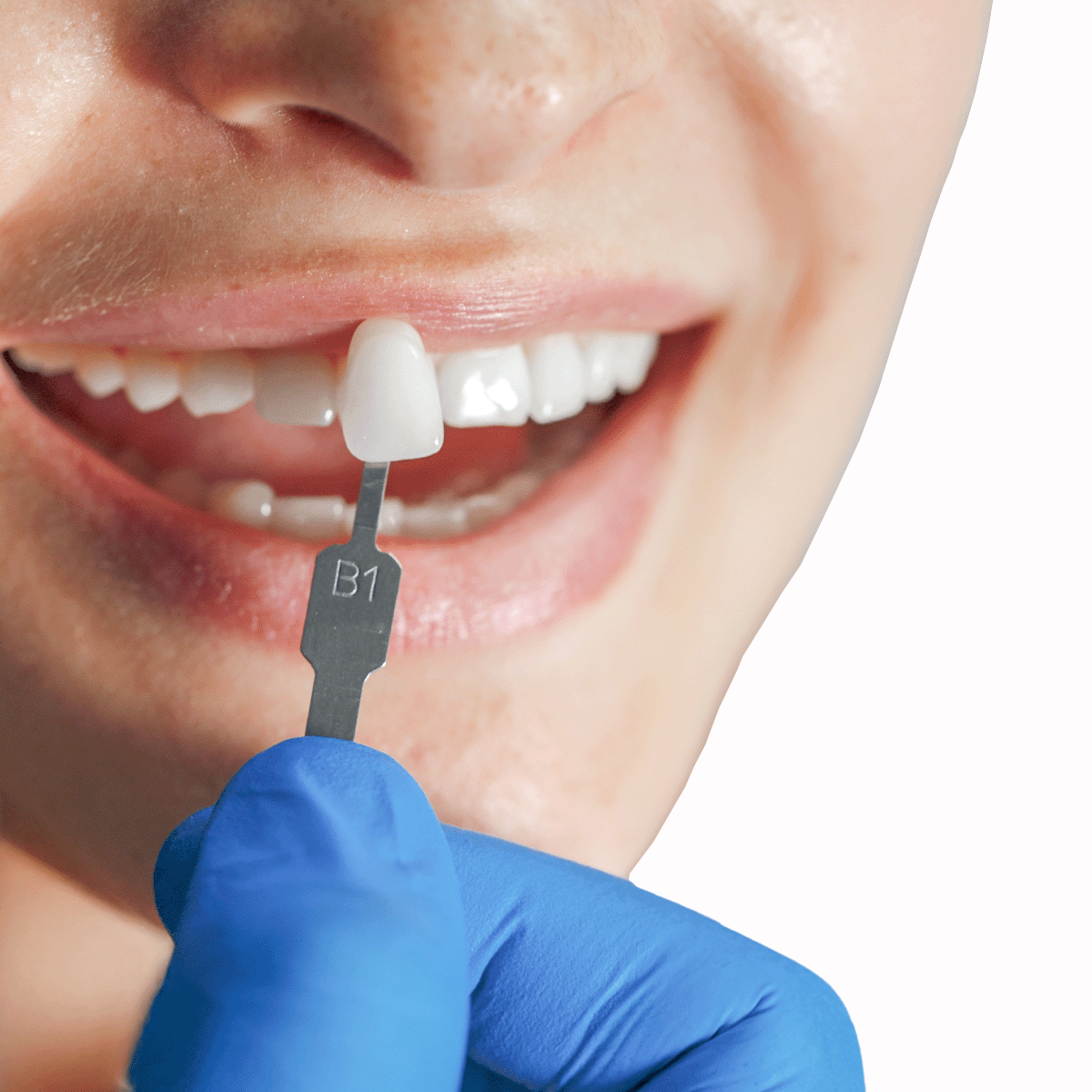 gio-healthy-direct-veneer