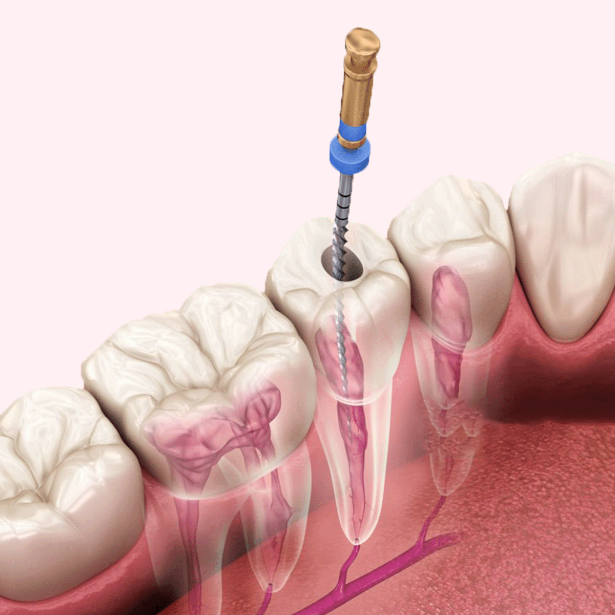 gio-endodontics-perawatan-syaraf-gigi