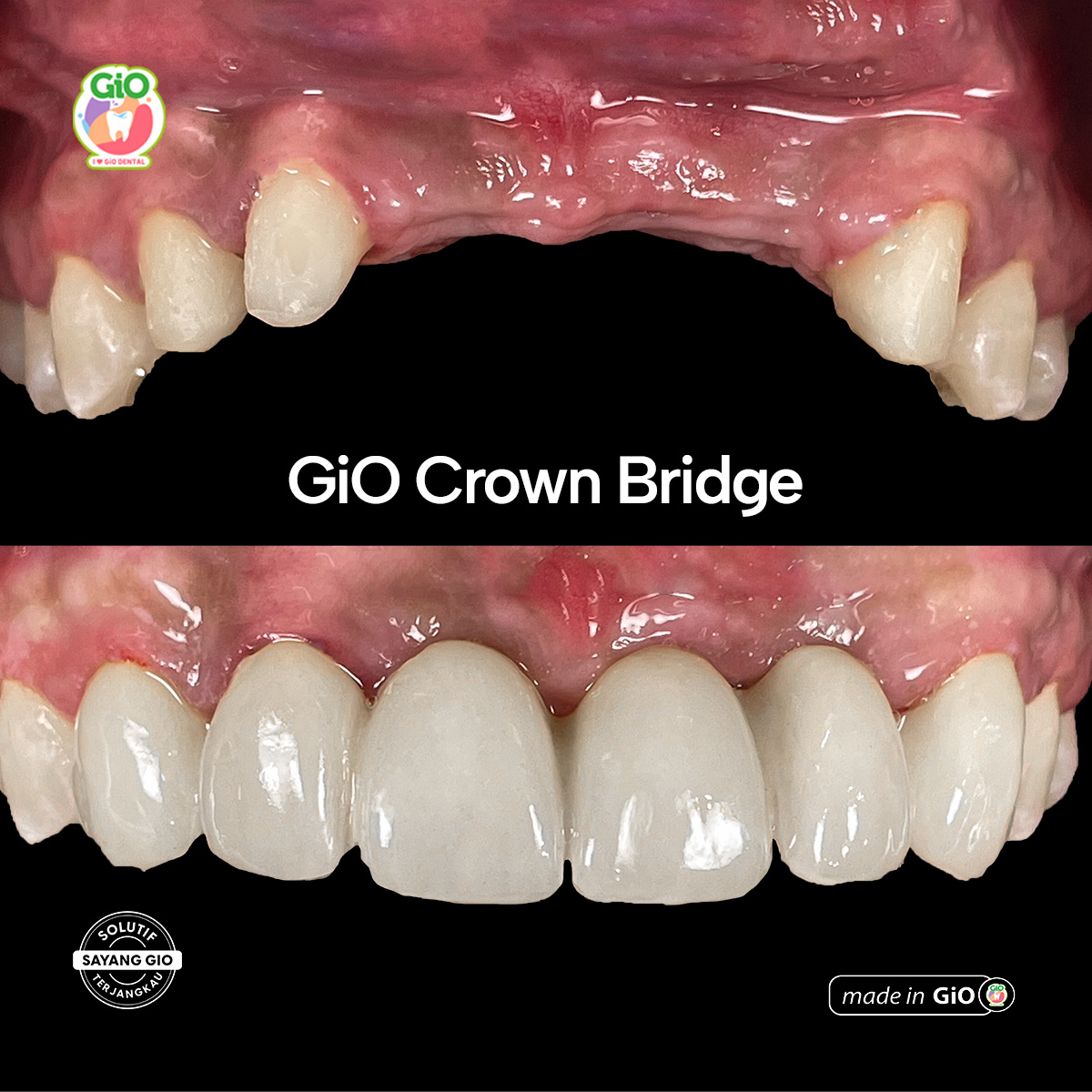 GiO Ceramic Crown