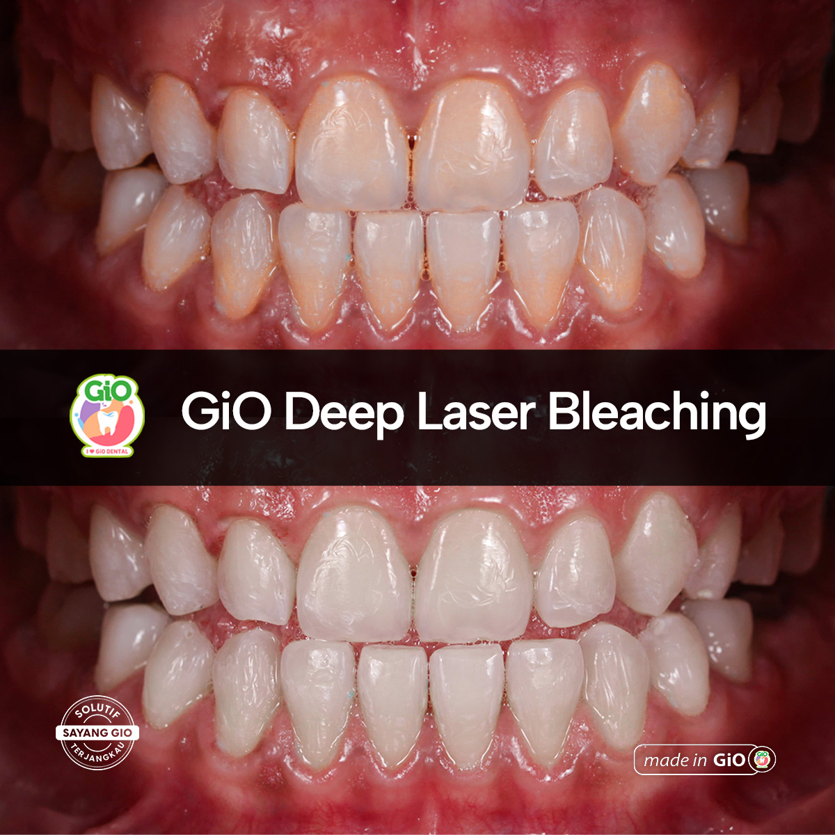 gio-deep-laser-bleaching
