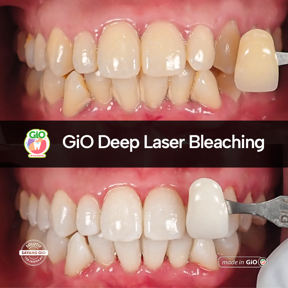 gio-deep-laser-bleaching
