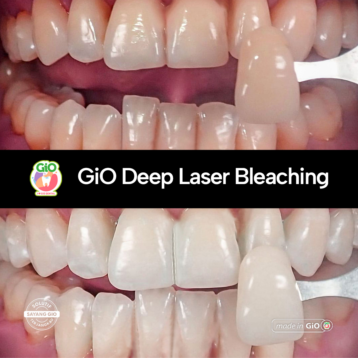 gio-deep-laser-bleaching