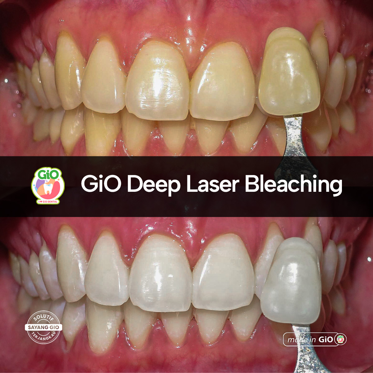 gio-deep-laser-bleaching