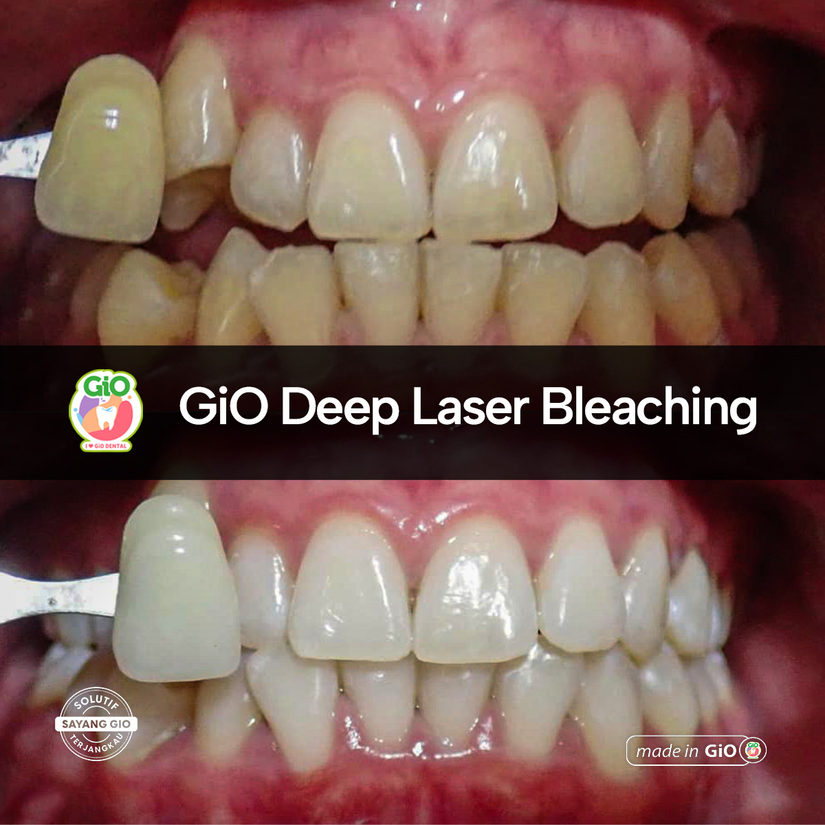 gio-deep-laser-bleaching