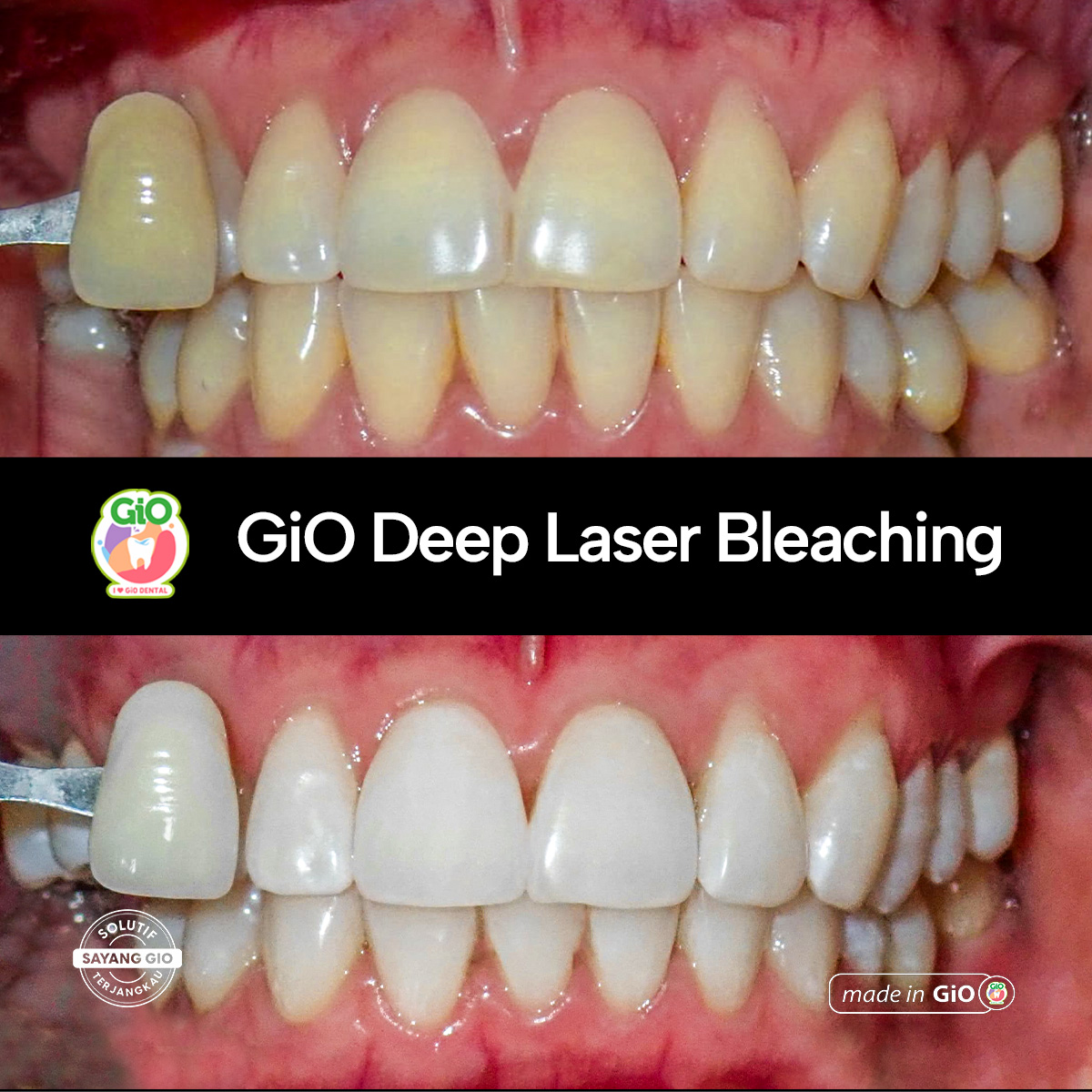gio-deep-laser-bleaching
