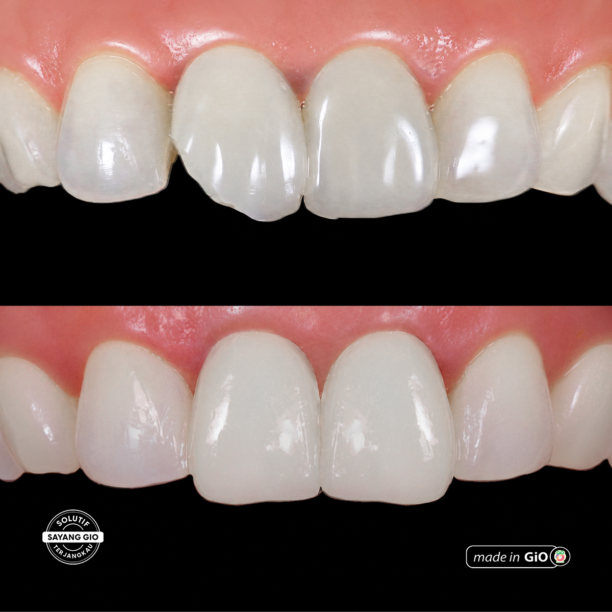 gio-healthy-veneer