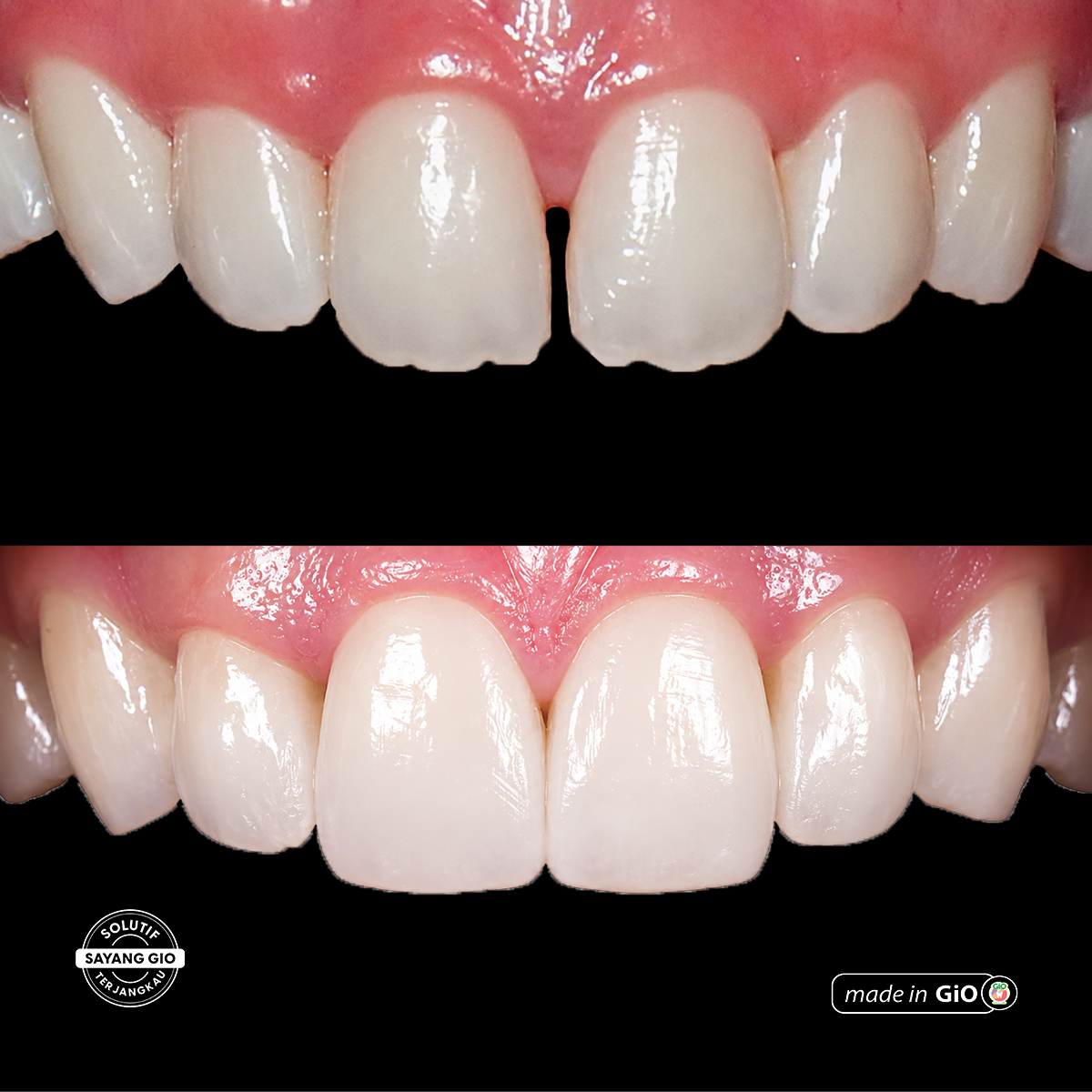 gio-healthy-veneer
