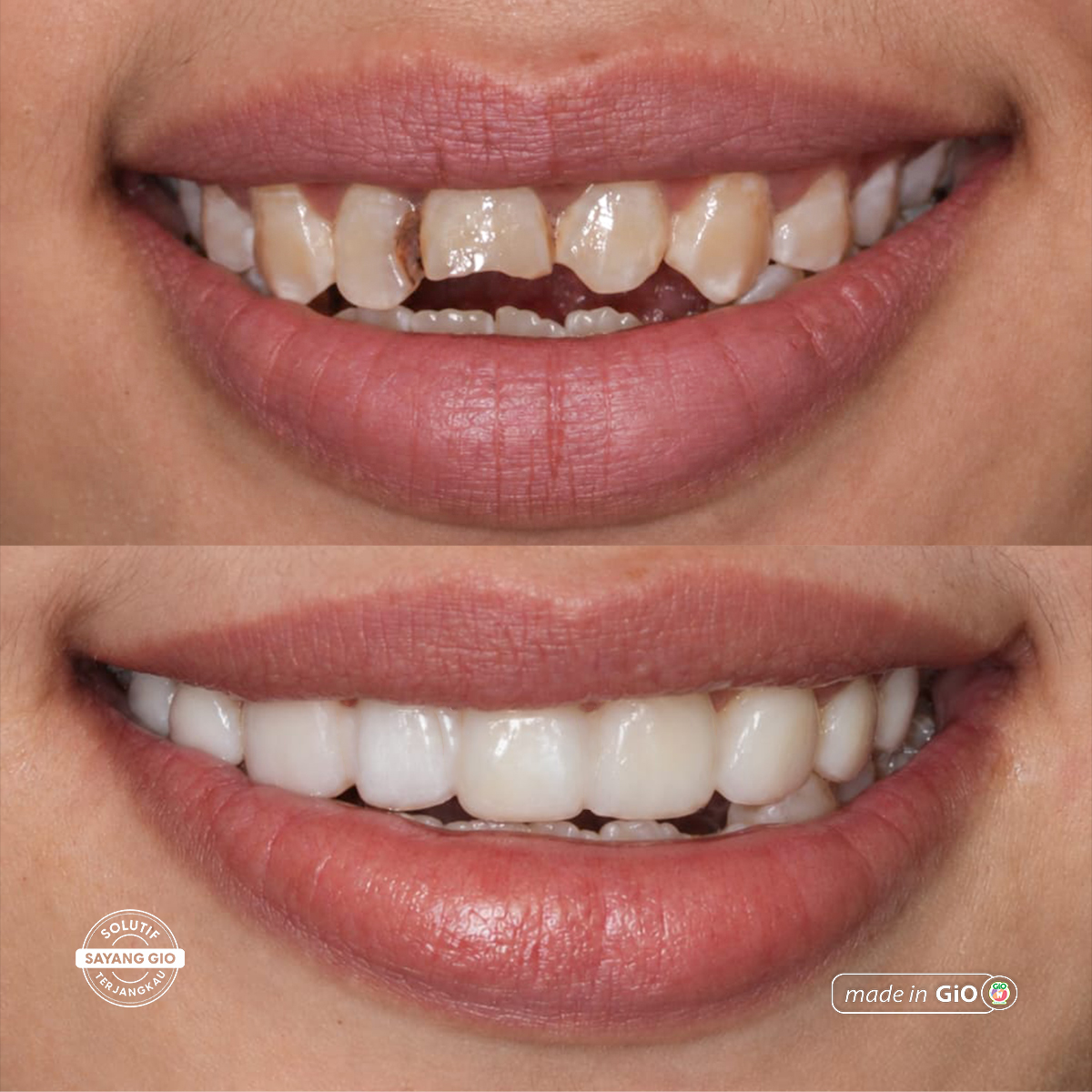 gio-healthy-veneer
