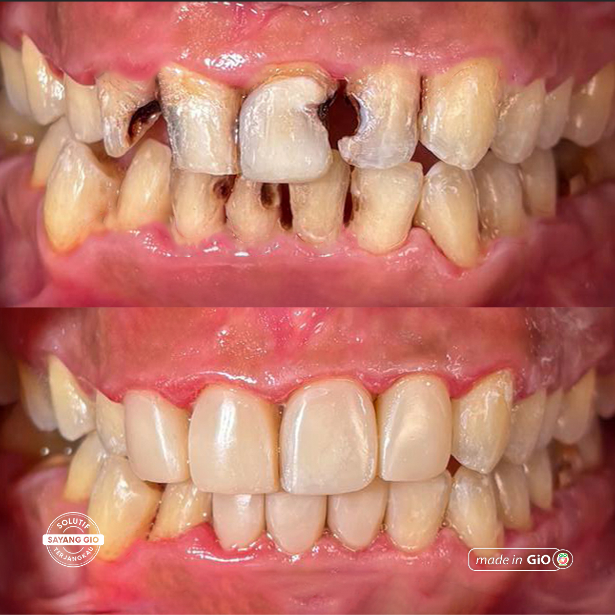 gio-healthy-veneer