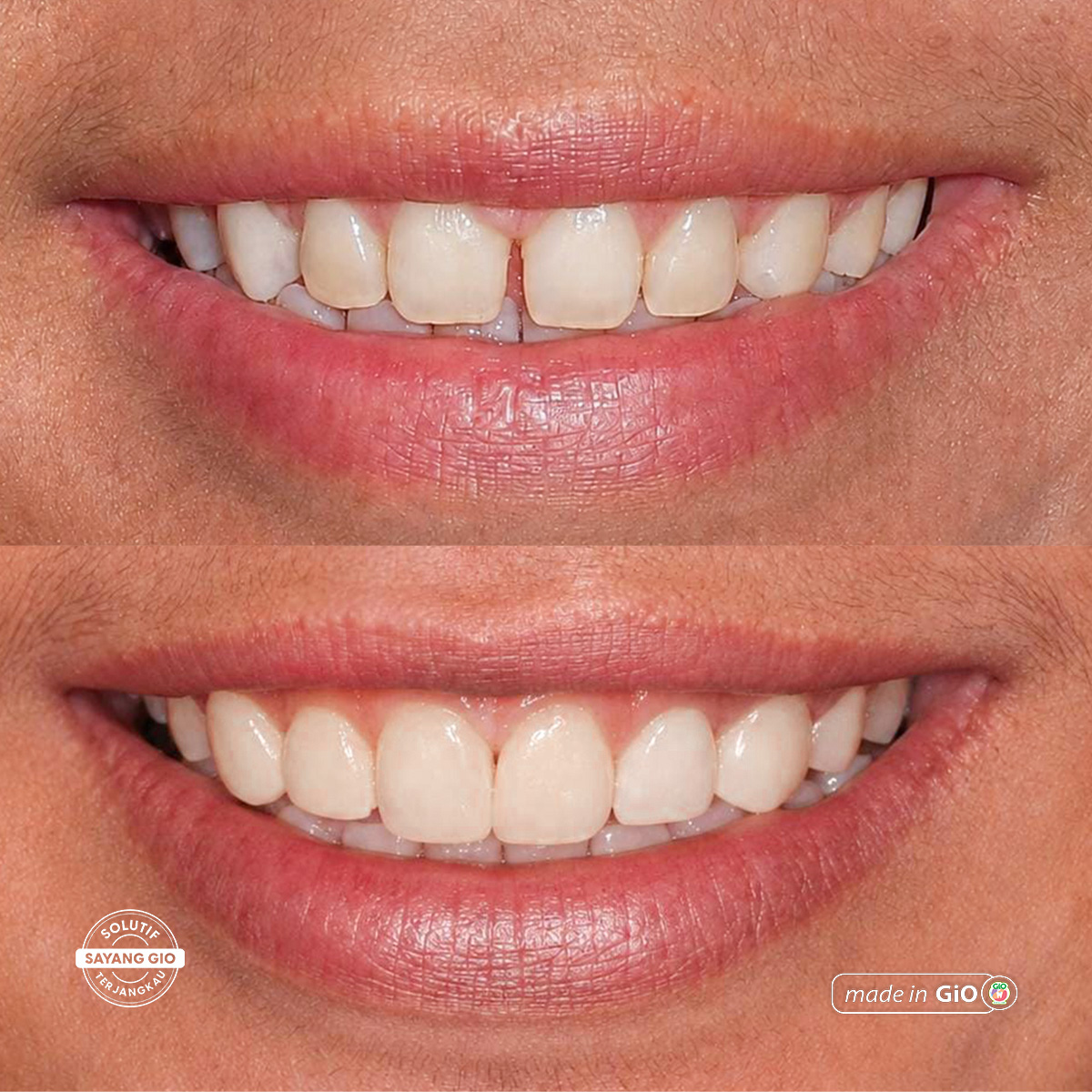 gio-healthy-veneer