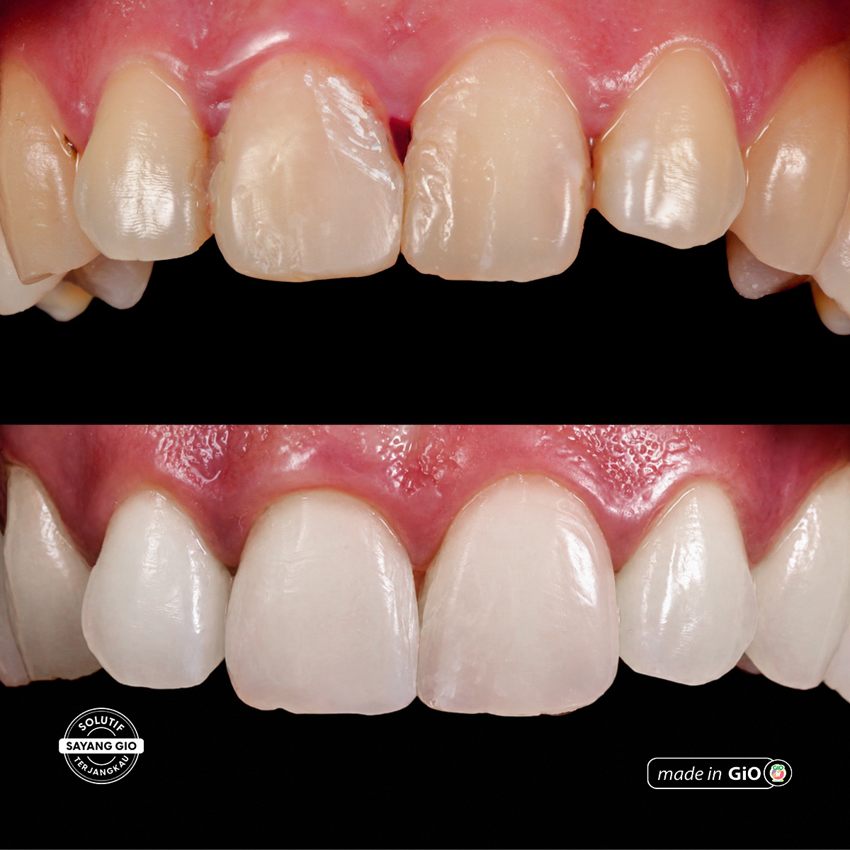 gio-healthy-veneer